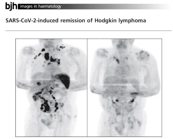 癌症晚期患者感染新冠1.jpg