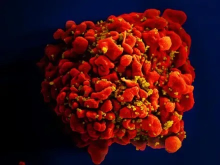 被 HIV 病毒颗粒（黄色）感染的 T 细胞